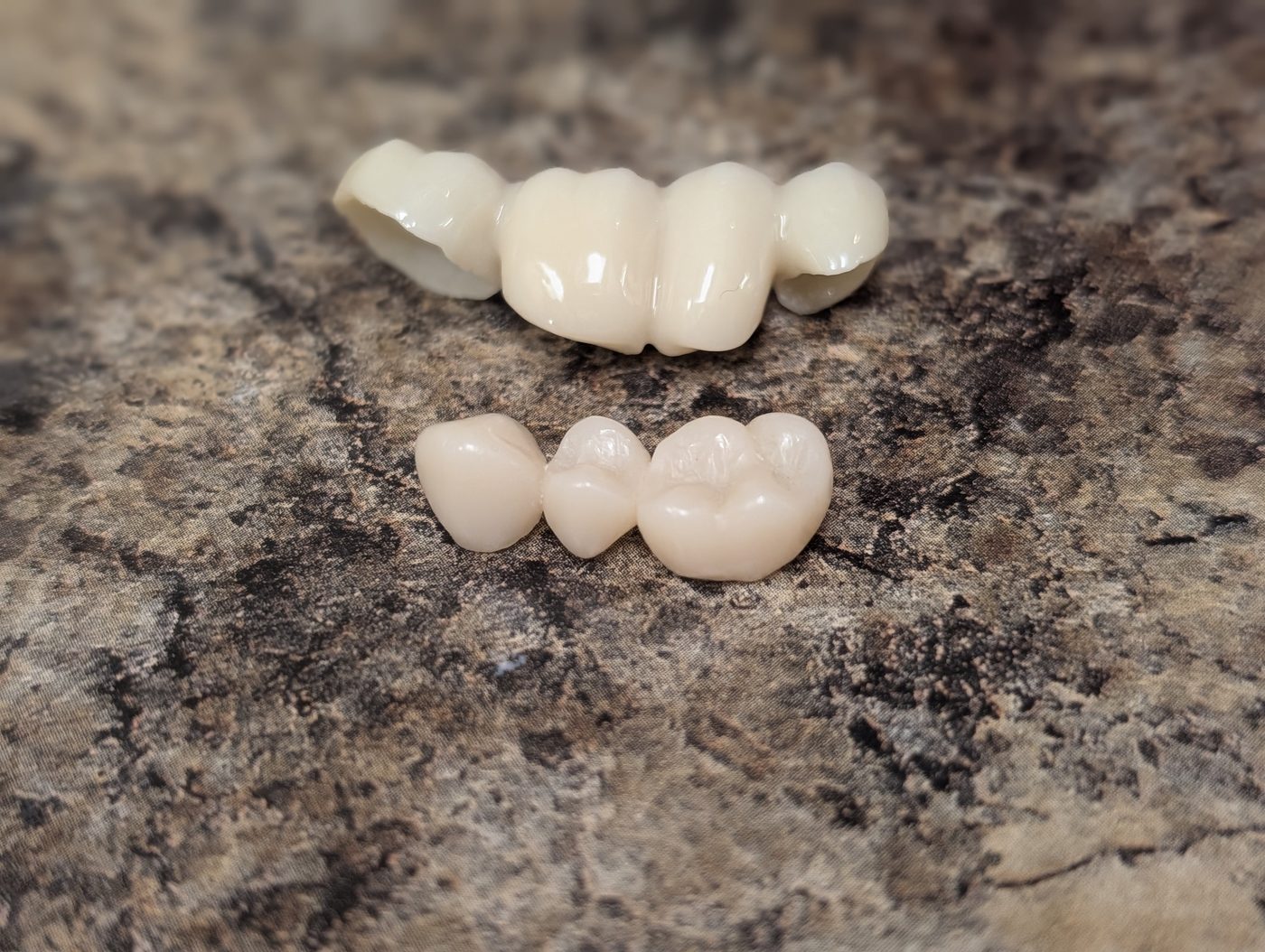 Same-day ceramic crown and bridge restorations milled in office
